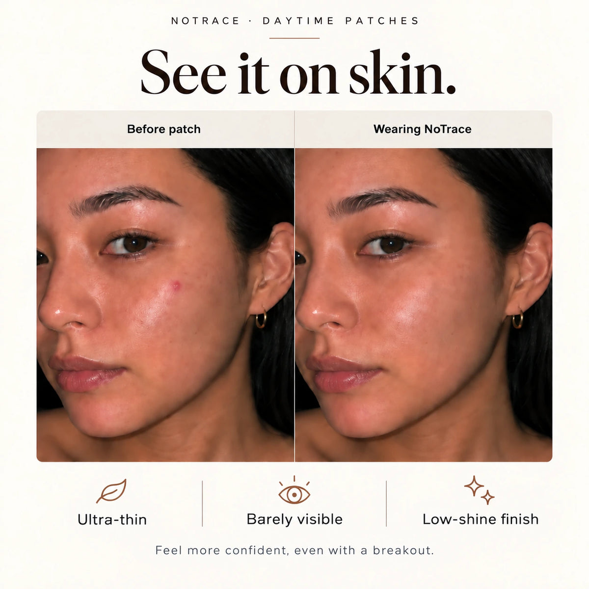 Before and wearing NoTrace. Feel more confident, even with a breakout.
