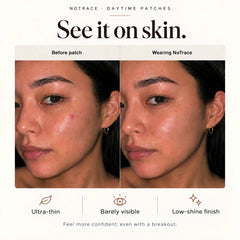 Before and wearing NoTrace. Feel more confident, even with a breakout.